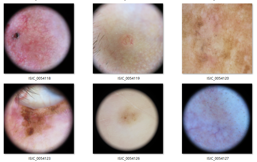 Skin cancer sample in BCN20000